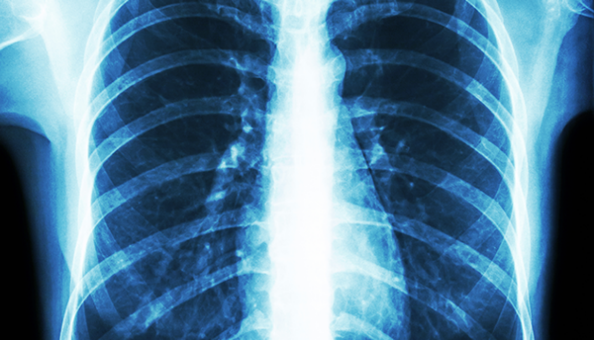 chest-x-ray
